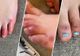 "COVID Toes" noul simptom al infectării cu coronavirus