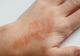Eczema: Cauze, simptome, tratament