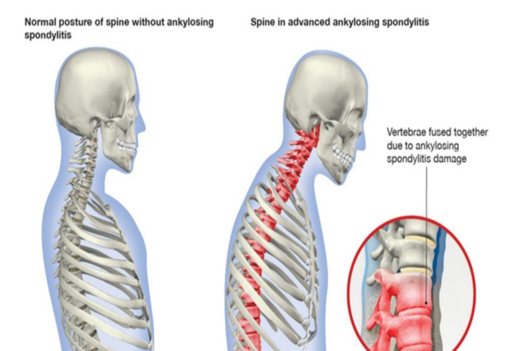 spondilartrita periferica tratament dureri la nivelul articulațiilor și mușchilor Ayurveda